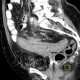 Diverticulitis, acute diverticulitis, peritonitis: CT - Computed tomography